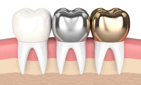 Maybe you would like to learn more about one of these? Dental Crown Richmond Hill Dentist Dentists Richmond Hill