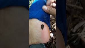 Mereka kemudian menghisap darah dari tuan rumah sampai mereka penuh, ketika mereka menarik rahang mereka dan mengantarkan ke dalam air. Lintah Hutan Menghisap Darah Youtube