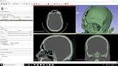Software livre para reconstrução de imagens provindas de equipamentos de tomografia computadorizada ou ressonância magnética. 3d Printable Skull From Ct Scan Details Part 1 Invesalius Youtube