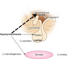 Image result for Hyperprolactinemia