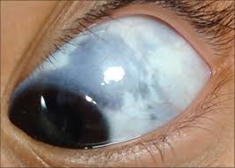 Image result for melanosis sclera