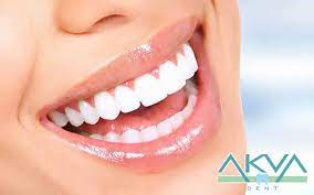 Ön diş estetik kaplama çeşitleri, fiyatları güncel bilgiler. Zirkonyum Dis Kaplama Fiyatlari 2021 Akvadent