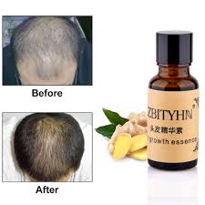 How fast does hair grow? Hair Growth Essence Liquid Fast Hair Growth Natural Extract Ginger Hair Growth Faster Oil Anti Hair Loss Nourishing 20ml Hair Loss Products Aliexpress