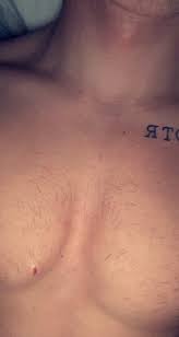 Sudden, sharp chest pain with shortness of breath, especially after a long period of inactivity. Trey S Trades V Twitter 2 Weeks Post Monitor Implant My Chest Hair Is Finally Growing Back Long On Chest Hairs Short On Razors