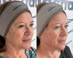 LIFTING FACIAL SIN CIRUGÍA