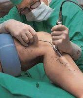 Tratamentul Chirurgical Pentru Varice