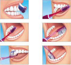 Disebabkan ada braces, ruang gigi jadi lebih kecil dan susah untuk memberus gigi secara normal. Cara Mengepam Gigi Dengan Betul Mengapa Apabila Anda Perlukan Sebelum Sarapan Pagi Atau Selepas Dan Berapa Kali Sehari Adakah Mungkin Untuk Menghapuskan Arahan Gigi
