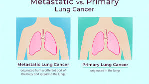 Epithelial lung tumors one of the types of tumors are called epithelial lung tumors. Metastatic Cancer To The Lungs Symptoms And Treatment