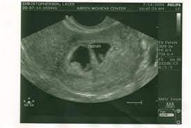 If you are vomiting, drink plenty. 3 Week 4 Days Pregnancy Symptoms Novocom Top