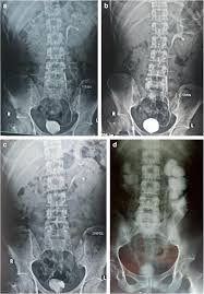 Image result for Genitourinary Tuberculosis