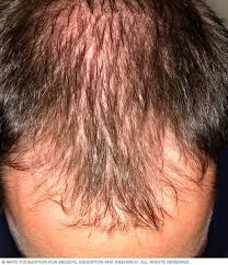 The thyroid, a gland in the neck, can sometimes cause hair loss if not working correctly. Hair Loss Symptoms And Causes Mayo Clinic