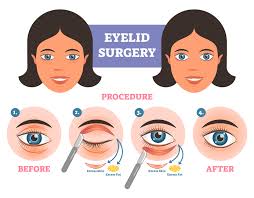 Eyelid Surgery Denver Eyelid Surgery Eye Makeup Tools Eyelid Lift
