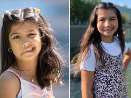 Patient with unilateral facial paralysis gets reanimation surgery