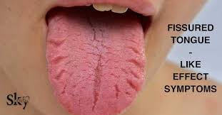 Image result for Fissured tongue