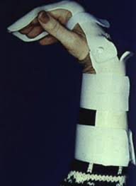 Jersey finger occurs when there is a strong contraction of the fdp. Finger Injuries Core Em