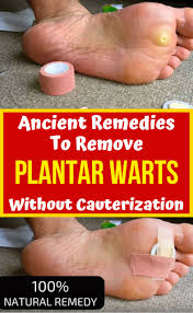Ancient Remedies To Remove Plantar Warts Without Cauterization Homeremedies Remedies Health H Planter Warts Remedies Home Remedies For Warts Planters Wart