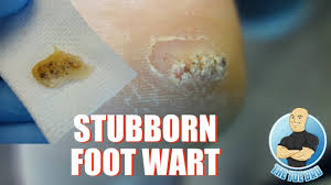 Member of howard sterns wack pack. How To Treat Difficult Plantar Warts Removal Foot Health Month 2018 9 Youtube
