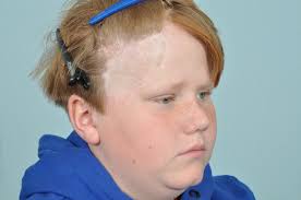 Brian O'Driscoll surprises young hair transplant patient