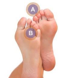 Pin On Mortons Neuroma