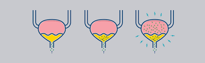 En dehors de l'ecbu, aucun. L Infection Urinaire Homme Les Symptomes Tena Men