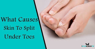 Maybe you would like to learn more about one of these? What Causes Skin To Split Under Toes