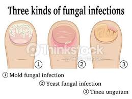 There is a lot of false information to be found on how to best treat toenail fungus and it can be frustrating to try to figure out the best treatment. Fungus Toenail Treatment Beaver Valley Foot Clinic
