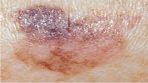 Superficial Spreading Melanoma Download Scientific Diagram