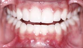Plaque provides the perfect environment for the bacteria that can cause gum disease to live and multiply. Silver Lake Dentist Difference Between Plaque Tartar