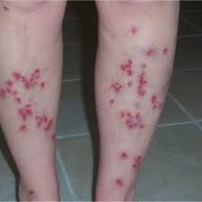 How do health care professionals diagnose morgellons disease? Morgellons Patient S Lower Legs Similar Lesions Covered Her Trunk And Download Scientific Diagram