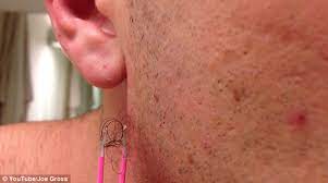 Your hair grows out of little pockets if you can actually see the hair loop above your skin, you could theoretically take a sterile needle, insert it under the loop, and try to gently lift out the. Disgusting Ingrown Hair