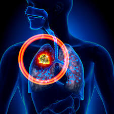 Ct scans are most often an outpatient procedure. Researchers Recommend Additional Pet Ct Scans In Lung Cancer Follow Up