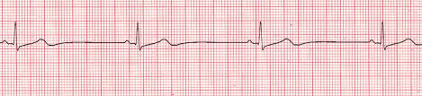 You Super Fun Dysrhythmias Arrhythmias Quiz Proprofs Quiz
