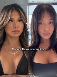 Masseter Muscle Women