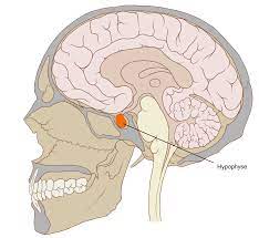 Pituitary Stalk Interruption Syndrome Wikipedia
