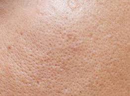 Large Pores Causes Treatments Dermatology And Laser Centre Of La