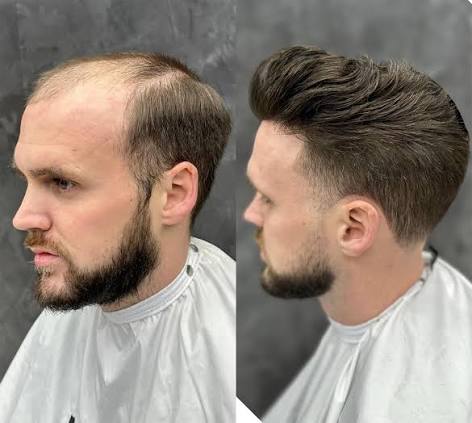 Mens hair system