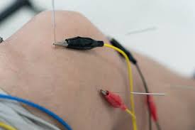 Image result for Electrical Stimulation Therapy