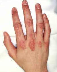 Educational image placeholder: dermatomyositis skin rash pattern