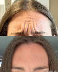 Image result for Forehead Regional Block