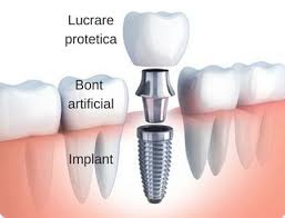 Pretul unei coroane dentare variaza intre 100 si 1200 de euro. Implant Dentar Ghid Complet Pentru Pacienti
