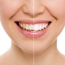 Maybe you would like to learn more about one of these? Do Whitening Strips Work Learn The Pros Cons Eagle Harbor Dentist