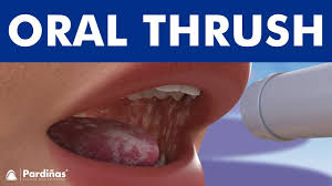 Image result for oral thrush symptoms roof of the mouth