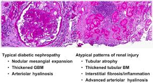 Image result for images Diabetic nephropathy