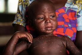 Measles stalks Central African Republic in Covid's shadow