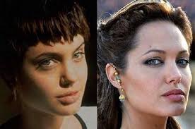 Pin By Mayra Gonzalez On Plastic And Cosmetic Surgery Rhinoplasty Angelina Jolie Nose Job Jennifer Aniston Nose