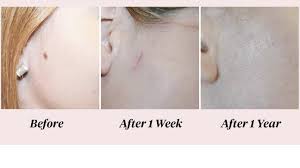 My shave biopsies take longer to heal and leave a burning sensation for several weeks. Mole Removal Scar Chances Care And Pictures