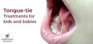 Image result for Ankyloglossia