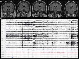 Aug 31, 2020 · the university of utah on instagram: Autoimmune Musicogenic Epilepsy Associated With Anti Glutamic Acid Decarboxylase Antibodies And Stiff Person Syndrome Jesus Ribeiro 2020 Clinical Case Reports Wiley Online Library