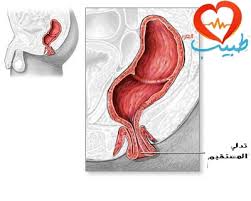 هبوط المستقيم أو تدلي الشرج Rectal Prolapse هبوط المستقيم بالصور