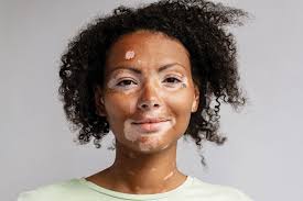 Image result for Vitiligo